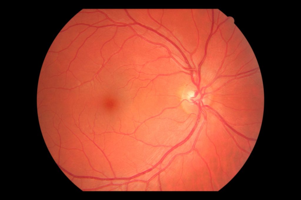 OCT the new buzzword in eye care Adrian Yssel Optometrists